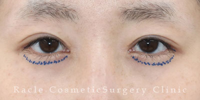 手術前デザイン