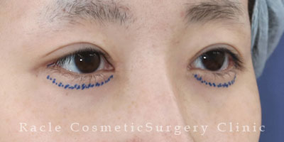 手術前デザイン