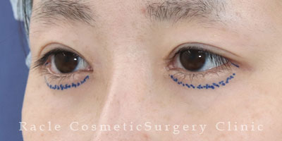 手術前デザイン