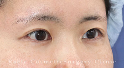 手術後12ヶ月目