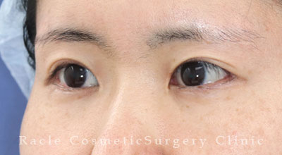 手術後12ヶ月目