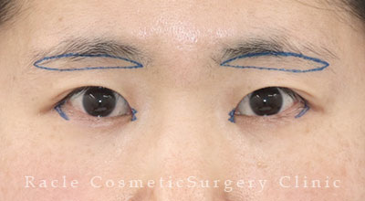 手術前デザイン