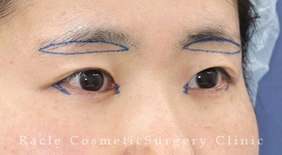 手術前デザイン