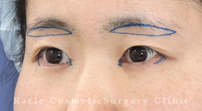 手術前デザイン