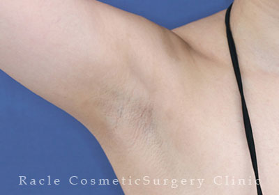 手術後12ヶ月目