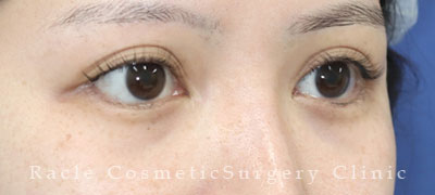 手術後12ヶ月目