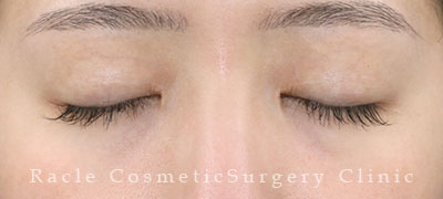 手術後12ヶ月目