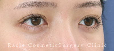 手術後12ヶ月目