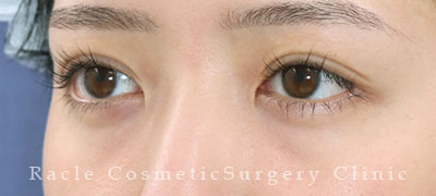 手術後12ヶ月目