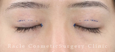 手術前デザイン