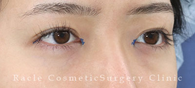 手術前デザイン