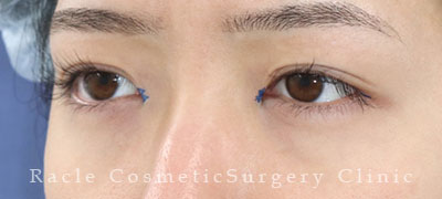 手術前デザイン