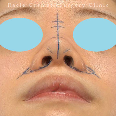 手術前デザイン