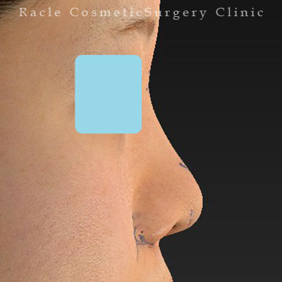 手術前デザイン