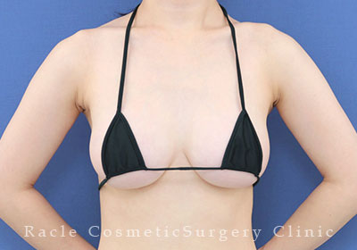 手術後12ヶ月目