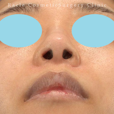 手術後12ヶ月目