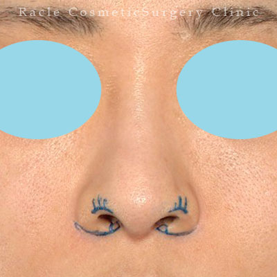 手術前デザイン