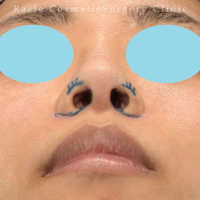 手術前デザイン