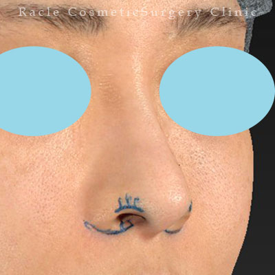 手術前デザイン