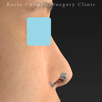 手術前デザイン