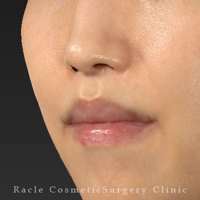 手術後12ヶ月目