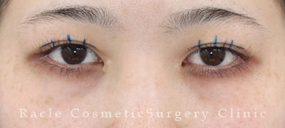 手術前デザイン