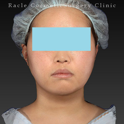 手術後12ヶ月目