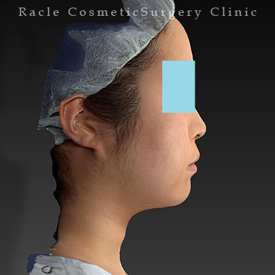 手術後12ヶ月目