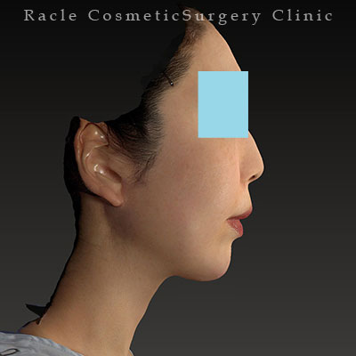 手術後12ヶ月目