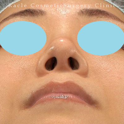 手術後12ヶ月目