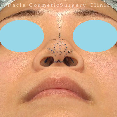 手術前デザイン