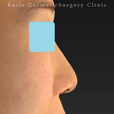 手術前デザイン