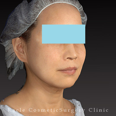 手術後12ヶ月目