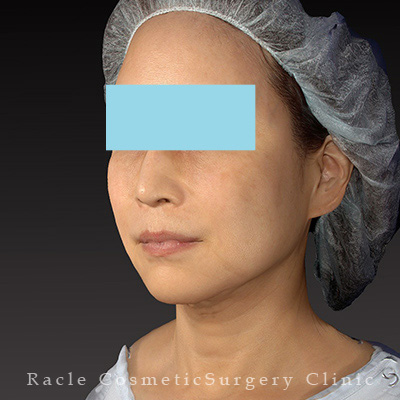 手術後12ヶ月目