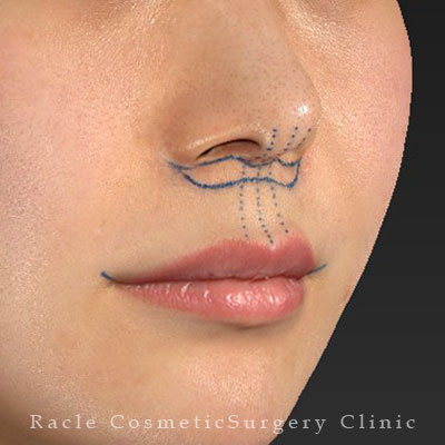 手術前デザイン