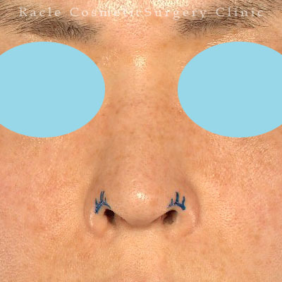 手術前デザイン