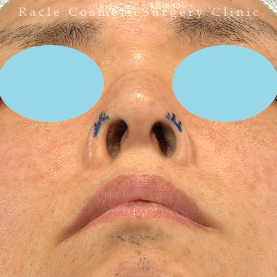 手術前デザイン