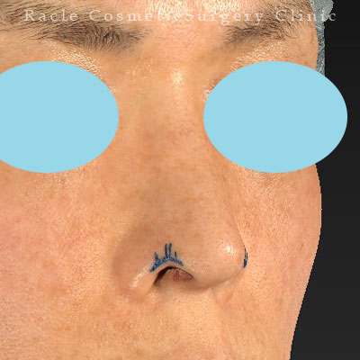 手術前デザイン