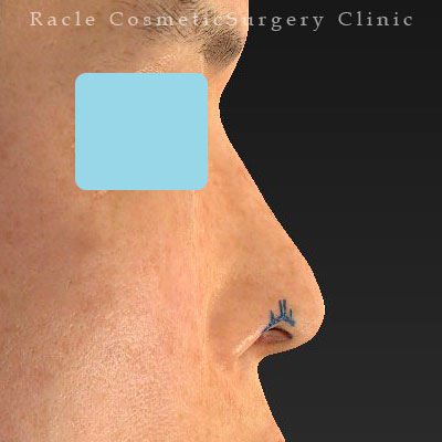 手術前デザイン