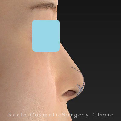 手術前デザイン