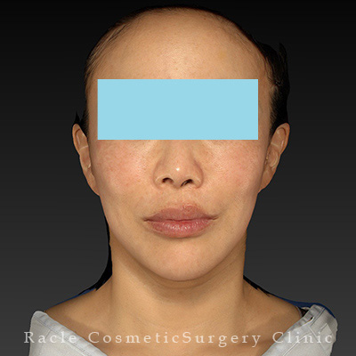 手術後12ヶ月目