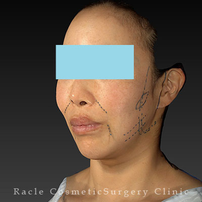 手術前デザイン