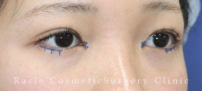 手術前デザイン