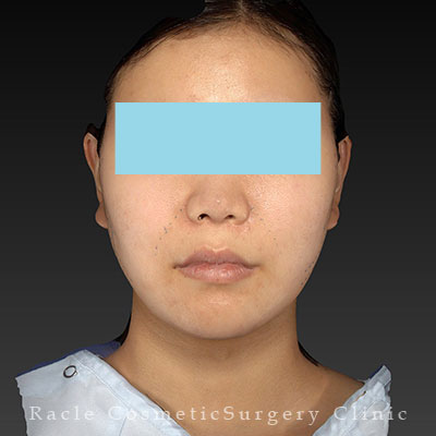 手術前デザイン