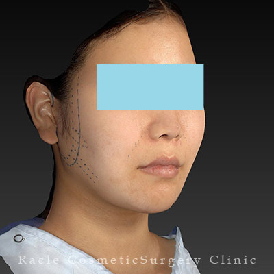 手術前デザイン