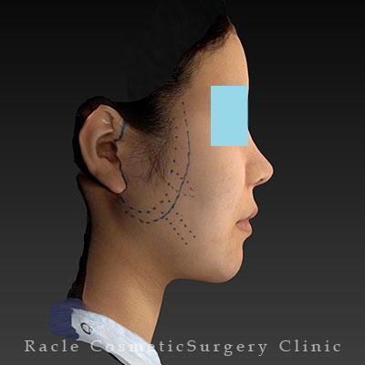 手術前デザイン