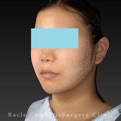 手術前デザイン