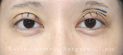 手術前デザイン