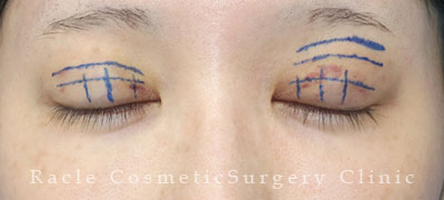 手術前デザイン