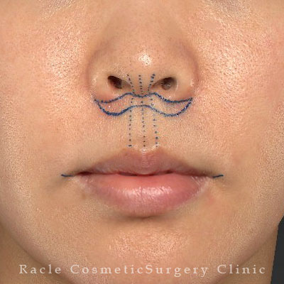 手術前デザイン